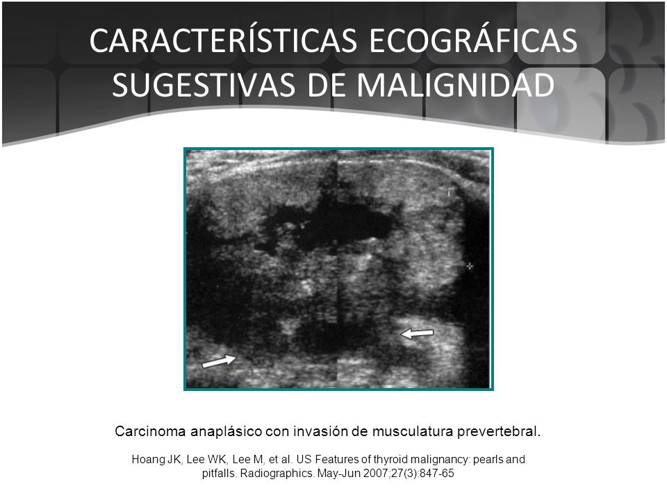 Imagenes ecograficas de tiroides